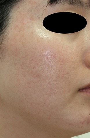 赤みを帯びたニキビ跡治療の症例写真（治療６回後右側）310px