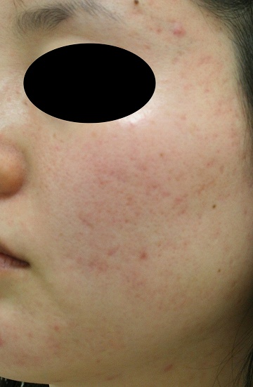 赤みを帯びたニキビ跡治療の症例写真（治療前左側）360px
