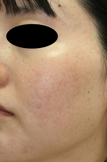 赤みを帯びたニキビ跡治療の症例写真（治療６回後左側）360px