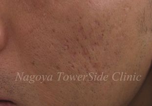 ２回治療後：パンチエレベーションによる深いニキビ跡治療（頬）の症例写真　310px