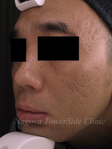 治療前：デルマパンチによる深いニキビ跡治療（頬・コメカミ全体）の症例写真　360px