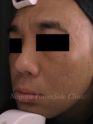 ４回治療後：デルマパンチによる深いニキビ跡治療（頬・コメカミ全体）の症例写真　280px