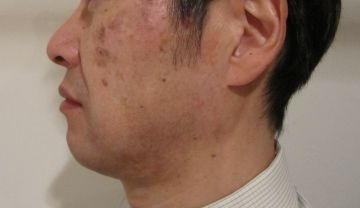 加齢性色素斑治療の症例写真（治療前）　360px